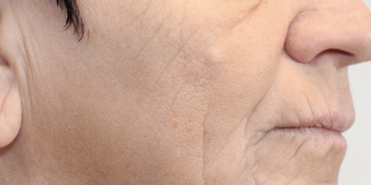 Resultaat na Dermatude Meta Therapy behandeling