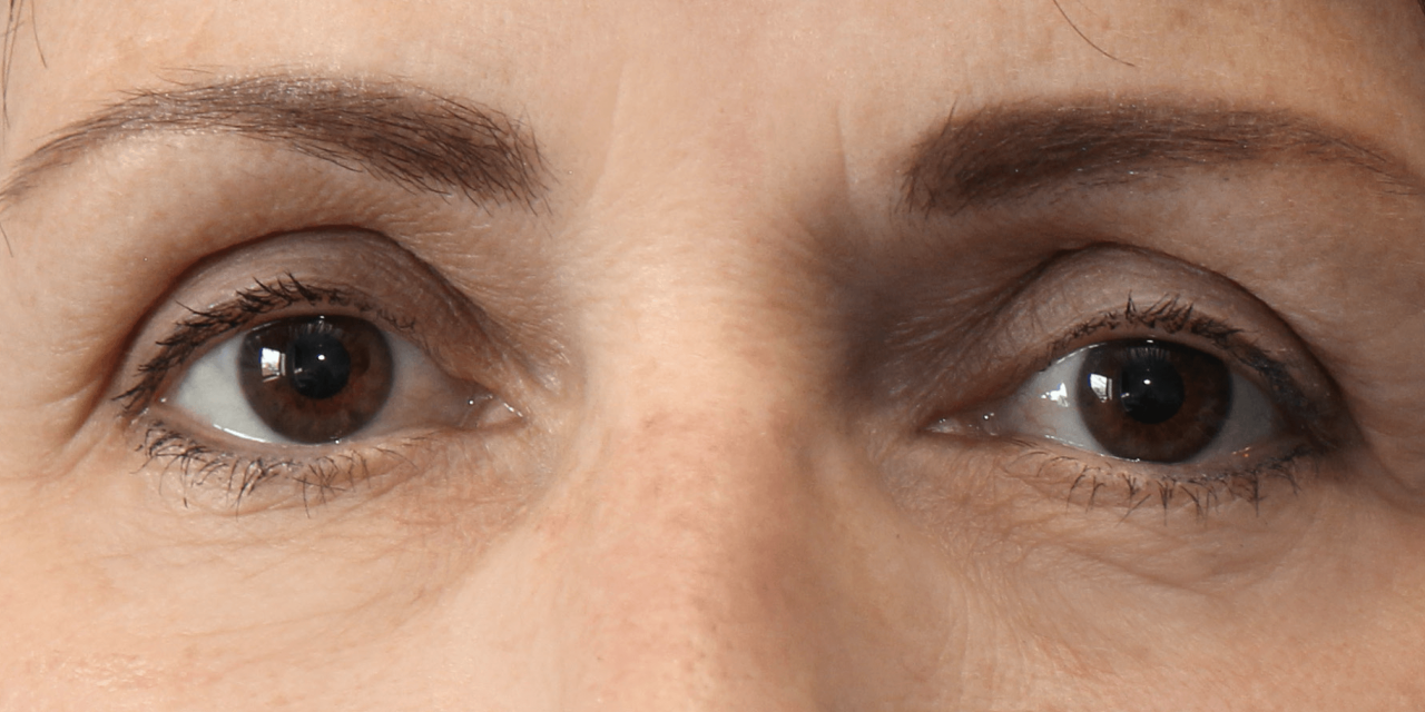 Ogen na Dermatude Meta Therapy behandeling