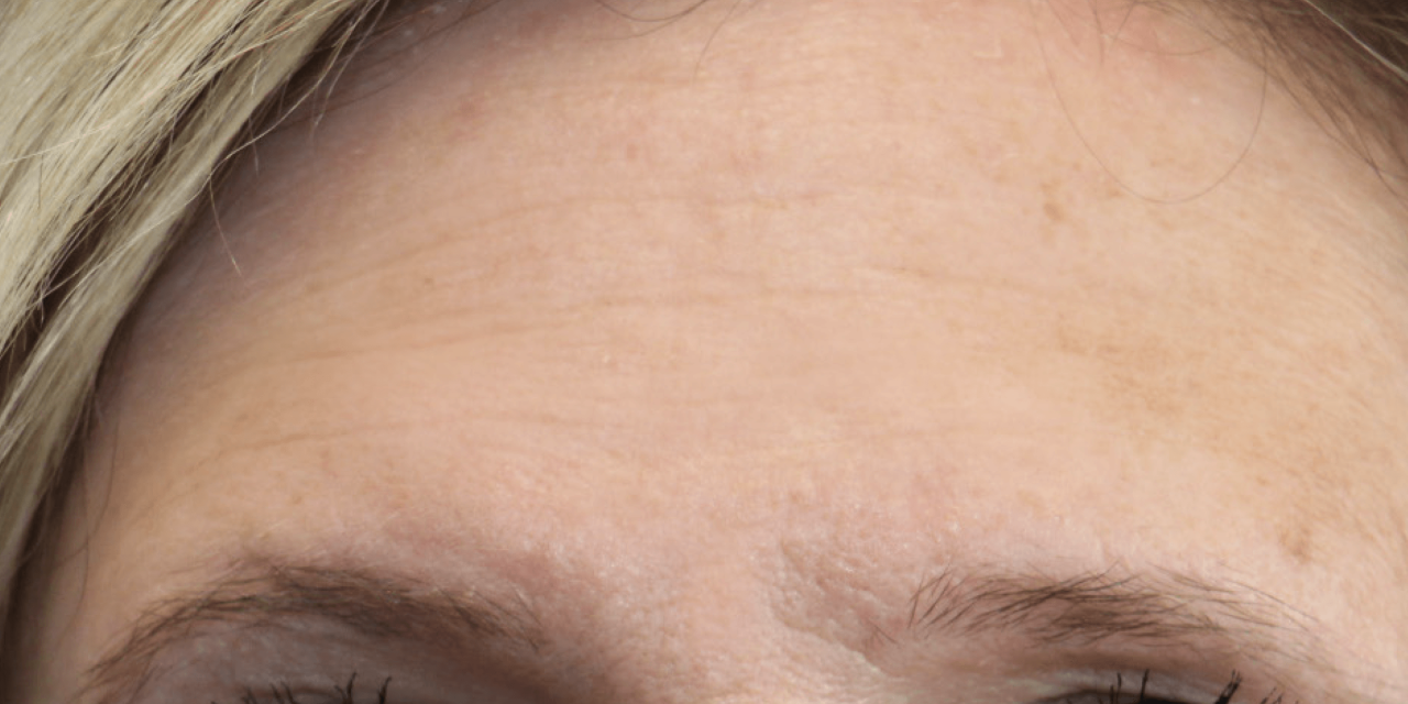 Voorhoofd resultaat na Dermatude Meta Therapy behandelingen