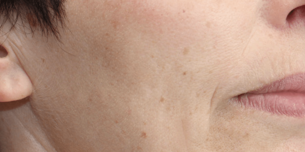 Resultaat rondom mond na Dermatude Meta Therapy behandeling