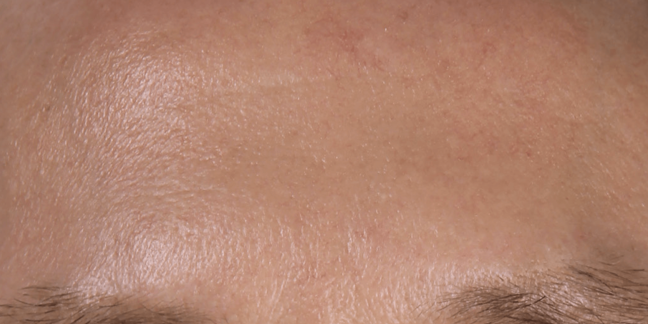 Strak voorhoofd na Dermatude Meta Therapy behandeling