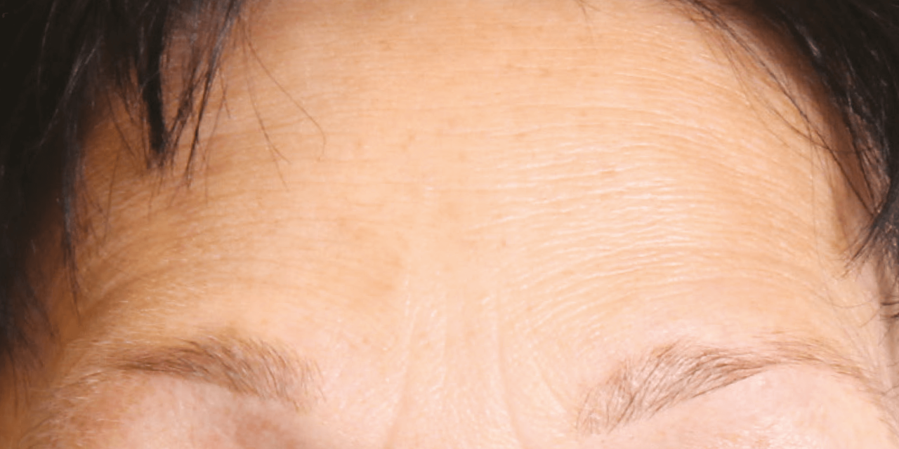 Strak voorhoofd na Dermatude Meta Therapy behandeling