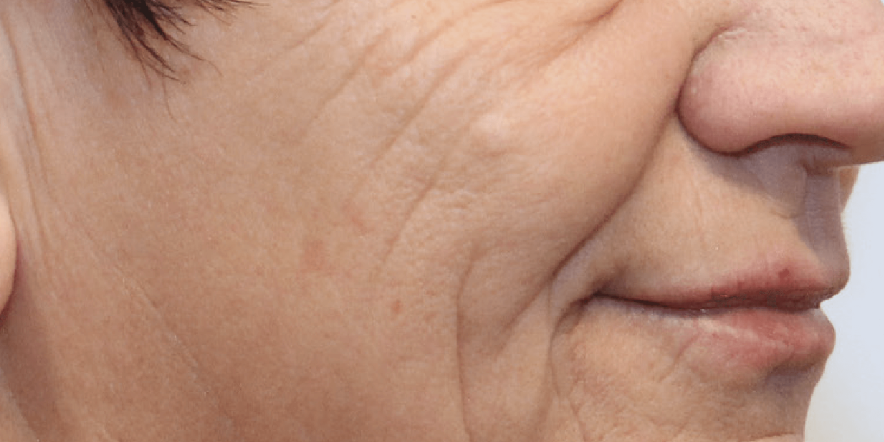Rimpels rondom mond voor Dermatude Meta Therapy behandeling