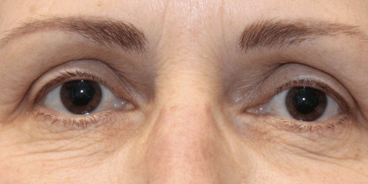 Rimpels onder ogen voor Dermatude Meta Therapy behandeling