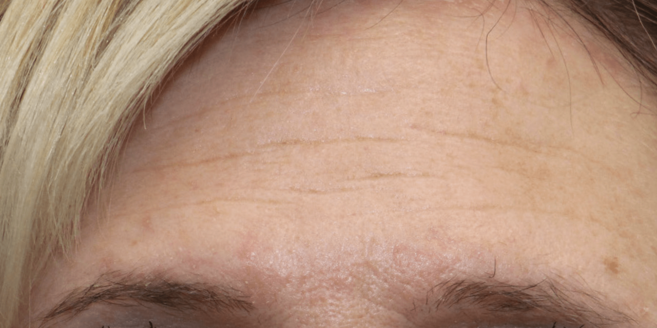 Rimpels op voorhoofd voor Dermatude Meta Therapy behandelingen