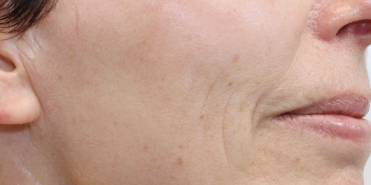 Rimpels rondom mond voor Dermatude Meta Therapy behandeling