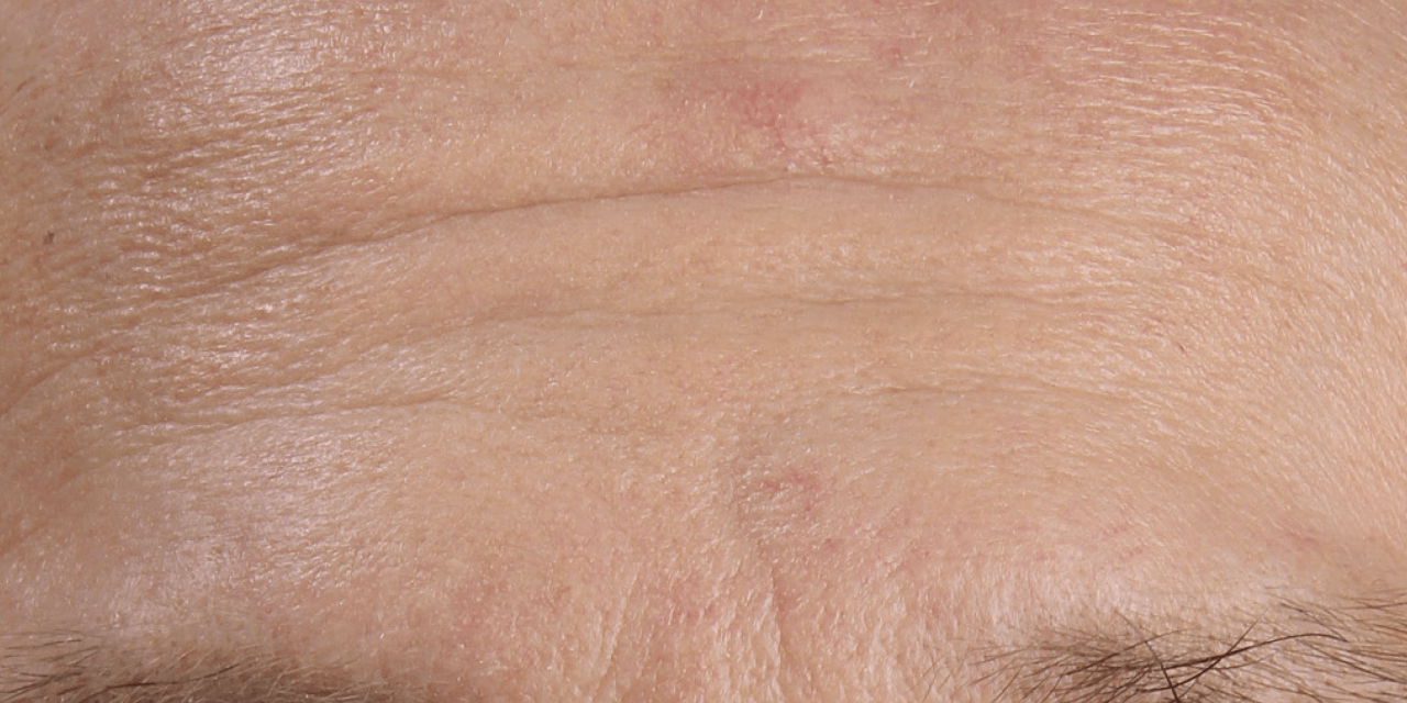 Rimpels op voorhoofd voor Dermatude Meta Therapy behandeling