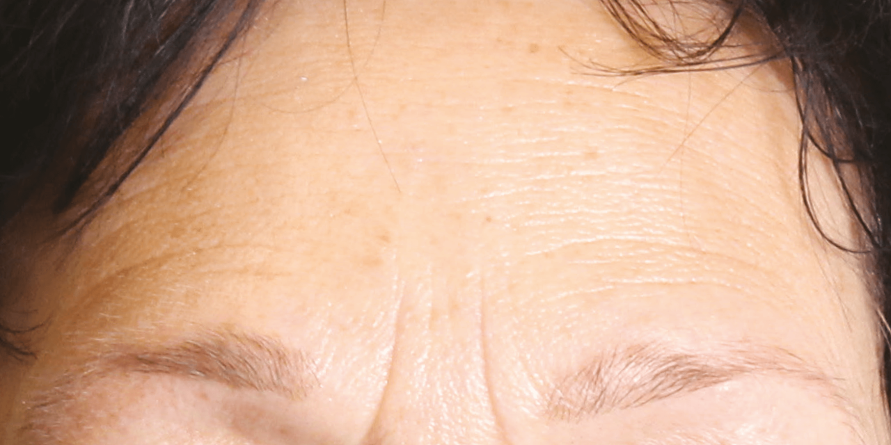 Rimpels op voorhoofd voor Dermatude Meta Therapy behandeling